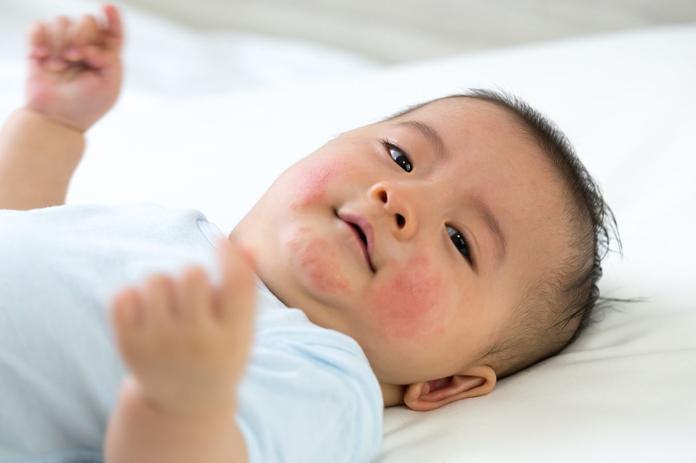 Mi bebé tiene granitos rojos en la cara: ¿Qué debo hacer?