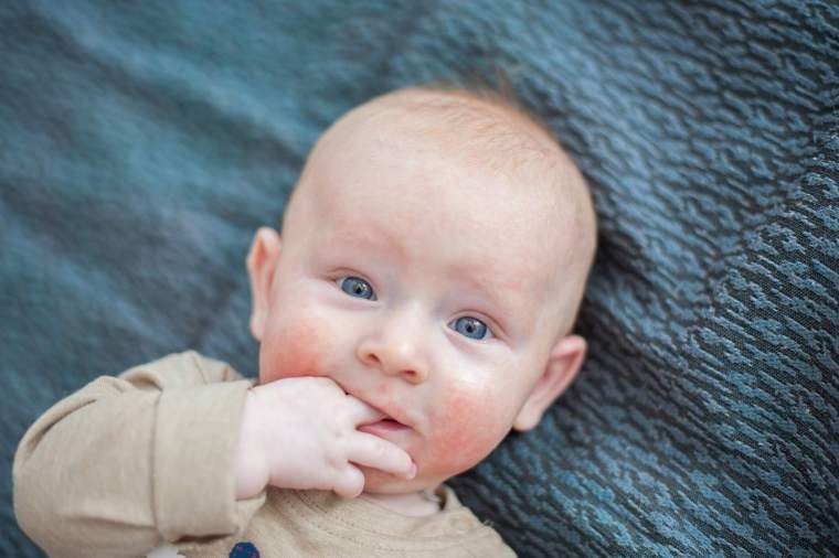 Conoce las tres alergias infantiles más comunes