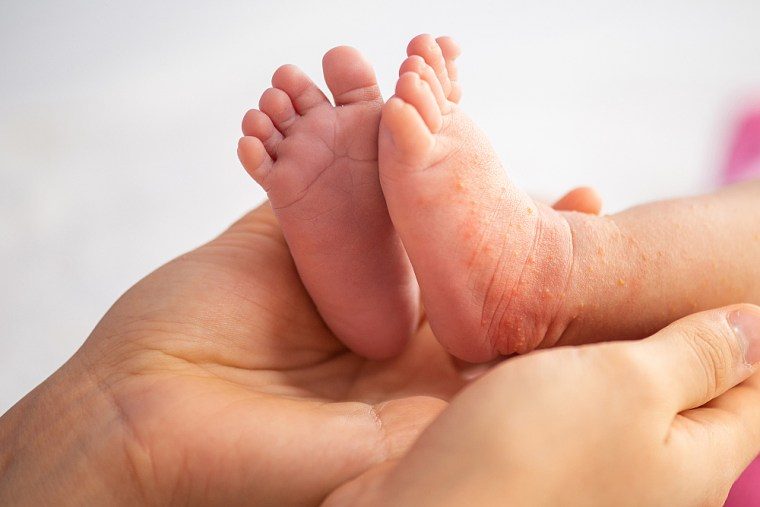 Sarpullido por calor en bebés: ¿Qué es y cómo tratarlo?