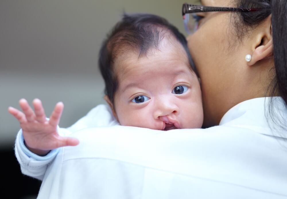 Bebés con labio leporino